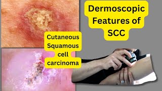 Dermoscopic features of SCCSquamous Cell Carcinoma [upl. by Frech707]