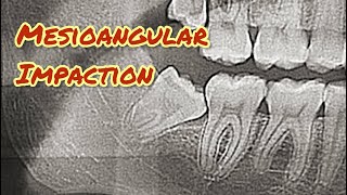 Mesioangular Wisdom Tooth Extraction Video StepbyStep drwahan [upl. by Teferi903]