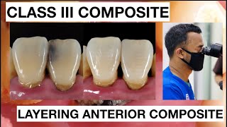 Step by Step Class III Composite Restoration  Dentist Griya RR [upl. by Seema]