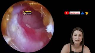 how to remove ear remove ear wax ear wax murine ear wax removal system how to remove ear wax [upl. by Odeen]