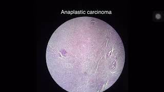 Thyroid gland  AnaplasticUndifferentiated carcinoma [upl. by Daht]