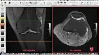 Systematic Interpretation of Knee MRI Supplemental Cases [upl. by Neehs394]