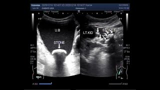 Ultrasound Video showing Pyonephrosis with multiple renal stones and a large vesical stone [upl. by Goodkin]