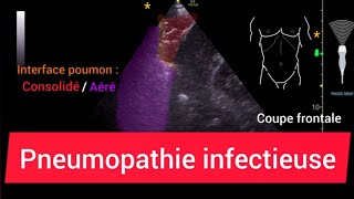 Pneumopathie Consolidation Échographie pulmonaire [upl. by Herald]