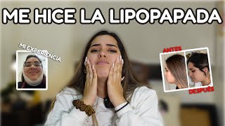 Mi experiencia con la Lipopapada  ANTES Y DESPUÉS [upl. by Notsgnik]