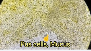 فحص الخروج Stool examination GSE Stool Analysis خلايا pus cells و bacteria Mucus [upl. by Itsa248]