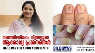 നഖത്തിലറിയാം നിങ്ങളുടെ ആരോഗ്യപ്രശ്നങ്ങൾ  Your Nails Can Tell About Your Health  Nails Warning [upl. by Weidman110]