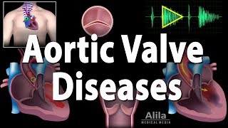 Aortic Valve Disease Animation [upl. by Northrup867]