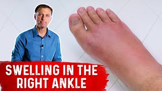 What Causes Right Ankle Edema [upl. by Yntrok]