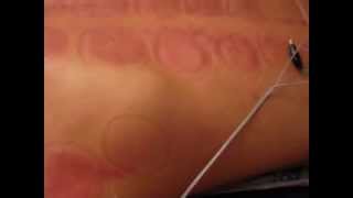 Acupuncture amp Electro Stimulation Session On My Back [upl. by Maroney]