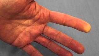 Raynauds Phenomenon Reduced Blood Flow of the FIngertip [upl. by Anirol]