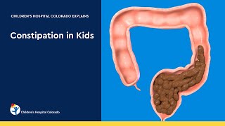 Pediatric Laxatives Senna vs PEG [upl. by Eiramanitsirhc536]