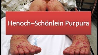 HenochSchönlein Purpura [upl. by Frame]