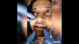 Demonstration of infraorbital nerve block [upl. by Gunning918]