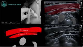 Sonographische Darstellung der seitlichen Nackenmuskeln [upl. by Jemy249]