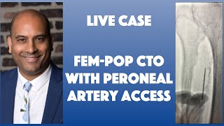 Live Case Peroneal Art Access To Cross FemPop and Peroneal Artery CTO [upl. by Ominoreg]