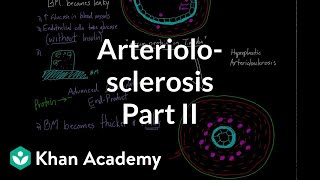 Arteriolosclerosis  part 2  Circulatory system diseases  Health amp Medicine  Khan Academy [upl. by Anaujal]