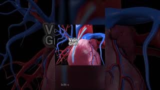 Double Bypass Heart Surgery 3danimation healthcare heart [upl. by Conover]