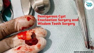 Dentigerous Cyst Enucleation Surgery and Wisdom Tooth Surgery [upl. by Gorges189]