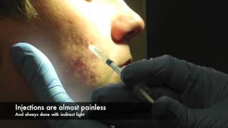 Dermal Fillers for acne scars [upl. by Ojeibbob785]