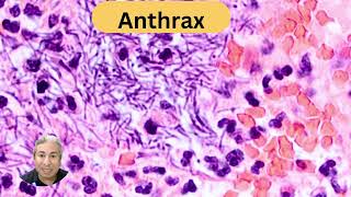 Anthrax enterocolitis [upl. by Hanan]