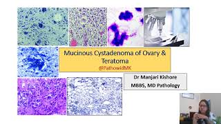 mucinous cystadenoma ovary amp teratoma ovary [upl. by Eiramanad266]