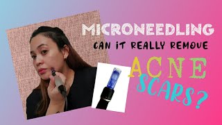 DIY MICRONEEDLING  You wont believe the result [upl. by Eseerehs]