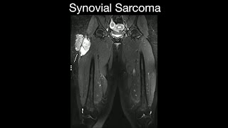 Synovial Sarcoma 1 [upl. by Haimaj]