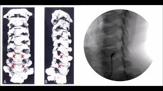 How to perform Stellate Ganglion Block Treatment [upl. by Ycaj735]