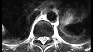 Epidural Hematoma with Spinal Cord Puncture Wound [upl. by Caines]