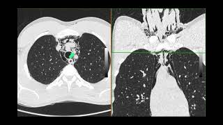 Pneumomediastinum [upl. by Odrawde146]