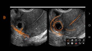 interstitial Ectopic pregnancy [upl. by Anthea388]