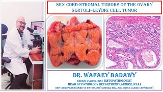 SEX CORD STROMAL TUMORS OF THE OVARY SERTOLI–LEYDIG CELL TUMOR BY DR WAFAEY BADAWY [upl. by Malissa425]