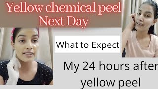 Yellow Chemical Peel  Next Day After Using Peel  Yellow Peel करने के बाद अगले दिन का face [upl. by Lednek620]