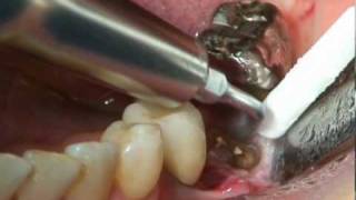 SATELEC  Extraction Molaire [upl. by Eph]