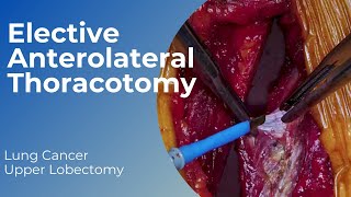 Anterolateral Thoracotomy for Upper Lobe Resection 12 [upl. by Ecenaj472]