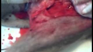 ablation tumeur testiculaire bergerwmv [upl. by Tenahs771]