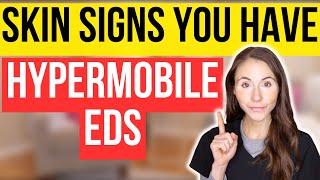 Unlocking The Secrets 12 Surprising Skin Signs Of Hypermobile EhlersDanlos Syndrome [upl. by Obadiah898]