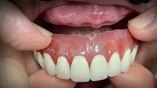 Finalizing a Highly Esthetic Denture with Dentist amp Patient InLab [upl. by Saxen]