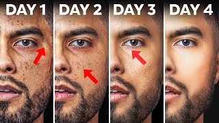 How To Fix Your Skin in 4 Days Use At Home Products [upl. by Babb]