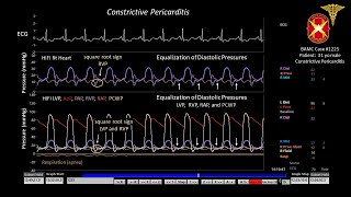 BAMC 1225 Constrictive Pericarditis and Pericardial Knock [upl. by Baxy]