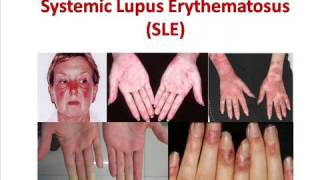 Systemic Lupus Erythematosus  SLE  Causes Signs amp Symptoms  Treatment [upl. by Nevi]