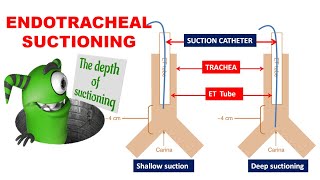 Endotracheal suctioning  Indications  Catheter selection  Preoxygenation  Duration of suction [upl. by Nybbor]