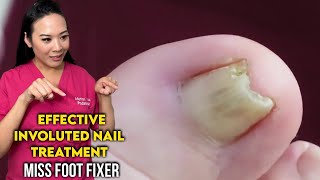 Effective Involuted Nail TreatmentGet Relief and Healthy Nails By Famous Podiatrist Miss Foot Fixer [upl. by Ltney]