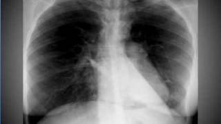 Chest xray Pneumomediastinum [upl. by Alcock118]