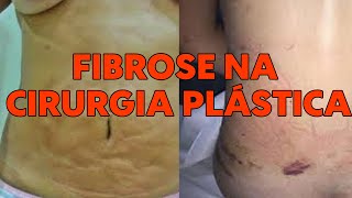 FIBROSE NA CIRURGIA PLÁSTICA [upl. by Seys558]