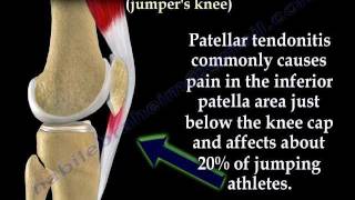 Patellar Tendonitis Jumpers Knee  Everything You Need To Know  Dr Nabil Ebraheim [upl. by Eentruok]