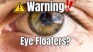 Eye Floaters Simple Explanation  What Are They [upl. by Azer51]