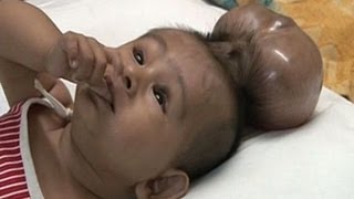 Baby Born With Two Heads  Extraordinary Birth [upl. by Odicalp]