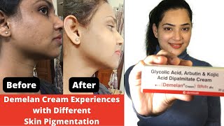 Demelan Cream Experiences with Different Skin Pigmentation  Demelan cream before and after pictures [upl. by Hamitaf]